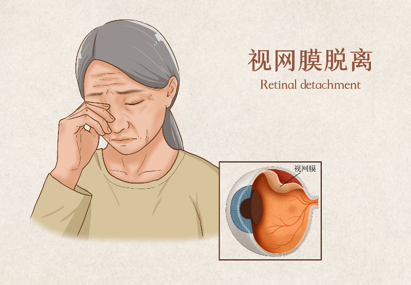 視網(wǎng)膜脫落手術費用
